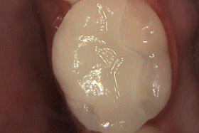 cerec