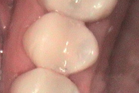 cerec