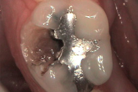 cerec