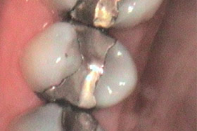 cerec